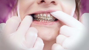 ASMR: upgraded braces with chain-link rubber bands and nitrile gloves (Arya Grander)